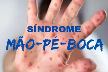 População é informada sobre a síndrome mão-pé-boca (SMPB)